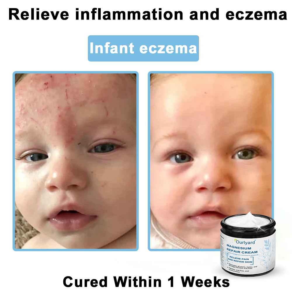 🏆✅Mayo Clinic Official: Magnesium skin repair cream (Eczema and Psoriasis Relief, Skin Repair, Even Tone, Acne and Dark Spot Treatment, Wart and Mole Removal)