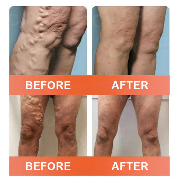 【Last Day Promotion 80% OFF】FDA Official: Seurico™ Vein Ease Microneedle Care Patch(For Spider Veins, Varicose Veins, Swelling & Leg Fatigue)