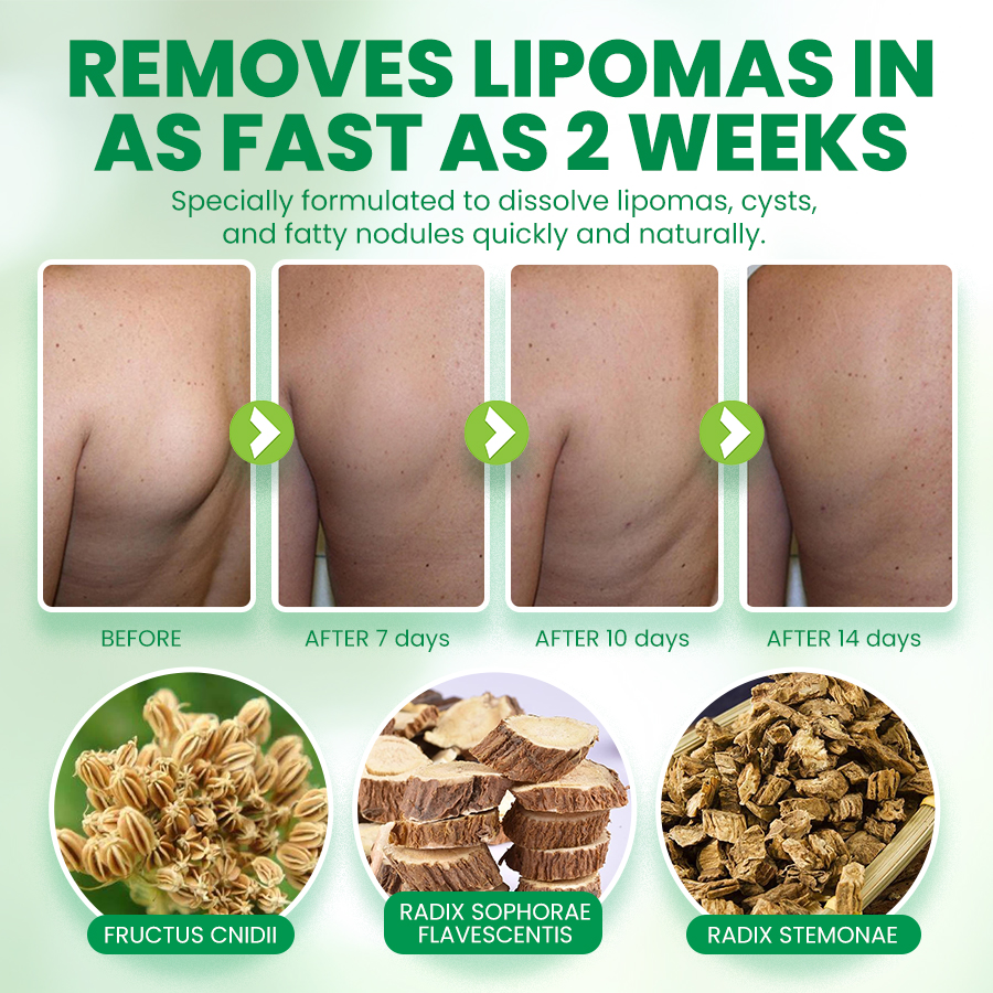 NEGUSY™Advanced Lipoma & Nodule Treatment Cream