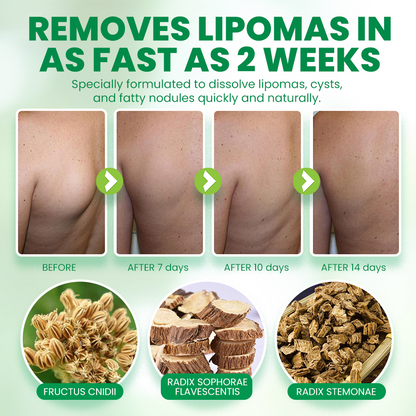 NEGUSY™Advanced Lipoma & Nodule Treatment Cream