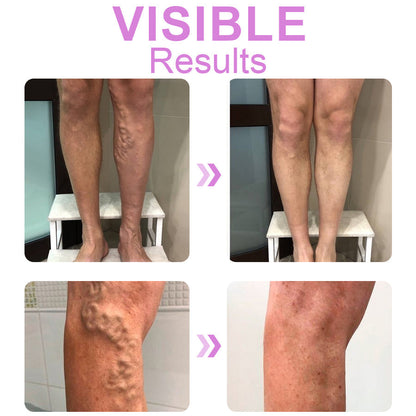 Seurico™ Varicose Veins Cream