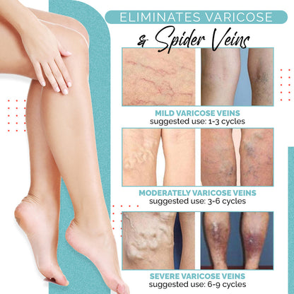 VariLuxe Varicose Veins Blue Light Treatment Pen