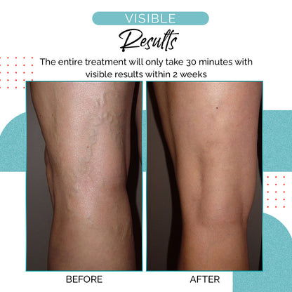 VariLuxe Varicose Veins Blue Light Treatment Pen