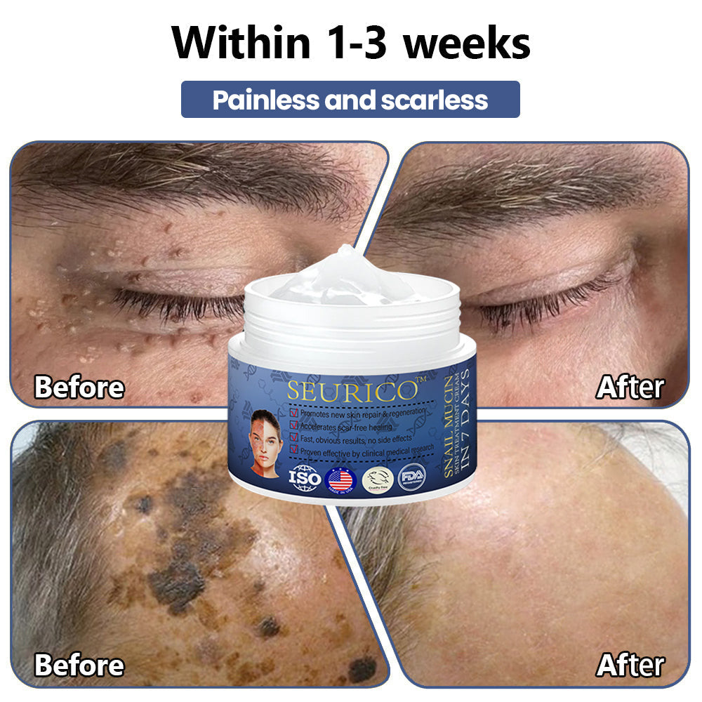 Seurico™ Snail Mucin Skin Treatment Cream (AAD Recommended👨‍⚕️)💖💟