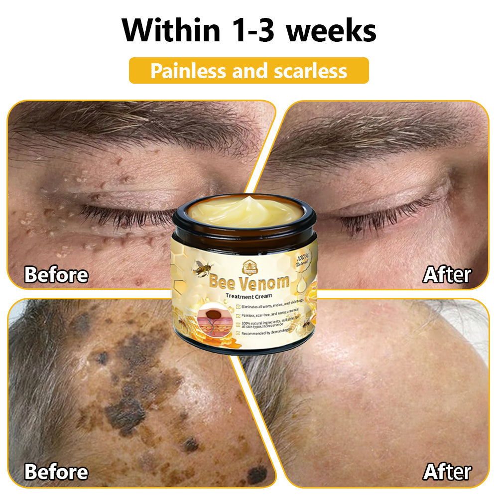 𝗧𝗟𝗢𝗣𝗔® Bee Venom Skin Treatment Cream (AAD Recommended👨‍⚕️)💖💟