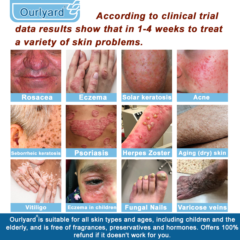 🏆✅Mayo Clinic Official: Magnesium skin repair cream (Eczema and Psoriasis Relief, Skin Repair, Even Tone, Acne and Dark Spot Treatment, Wart and Mole Removal)