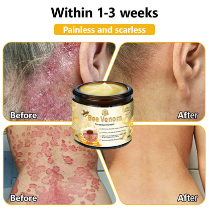 𝗧𝗟𝗢𝗣𝗔® Bee Venom Skin Treatment Cream (AAD Recommended👨‍⚕️)💖💟