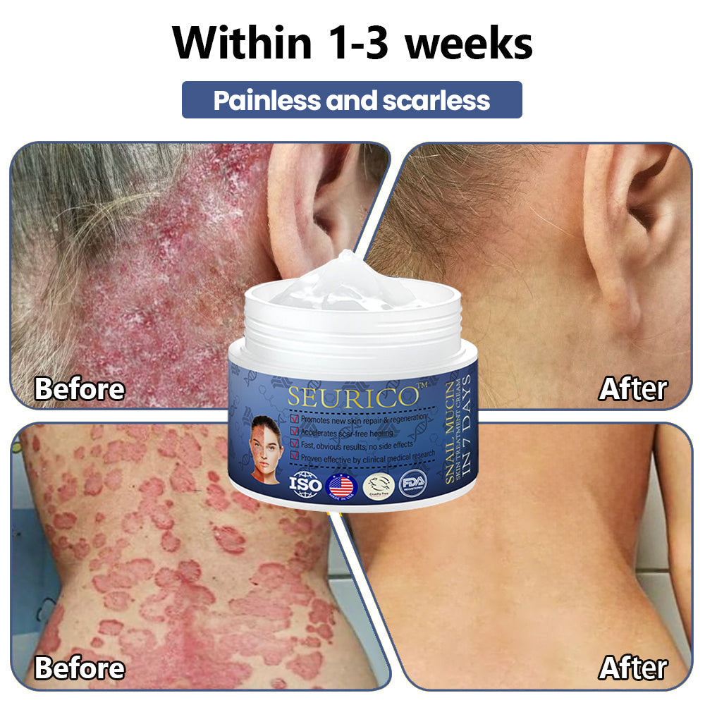 Seurico™ Snail Mucin Skin Treatment Cream (AAD Recommended👨‍⚕️)💖💟