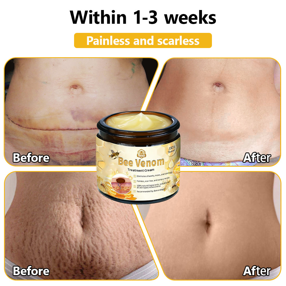 𝗧𝗟𝗢𝗣𝗔® Bee Venom Skin Treatment Cream (AAD Recommended👨‍⚕️)💖💟