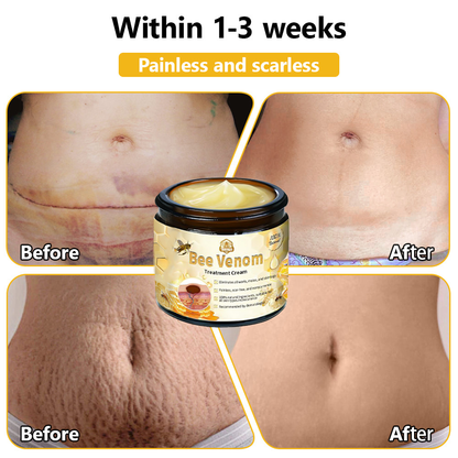 𝗧𝗟𝗢𝗣𝗔® Bee Venom Skin Treatment Cream (AAD Recommended👨‍⚕️)💖💟