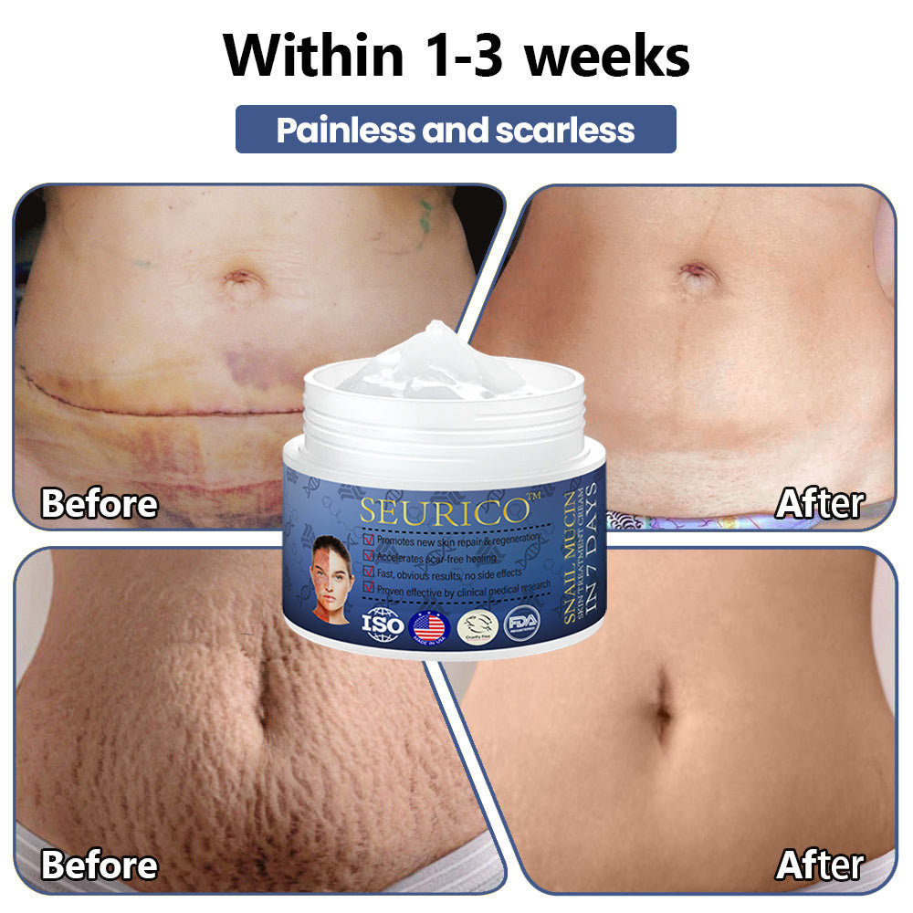 Seurico™ Snail Mucin Skin Treatment Cream (AAD Recommended👨‍⚕️)💖💟