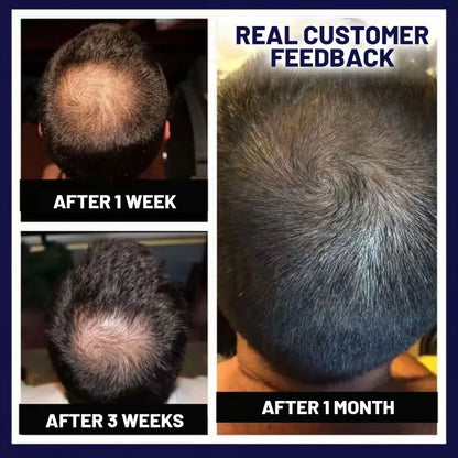 🌿 Odeiun™ Natural Hair Regrowth Spray – 70% OFF Ends Tonight! 🔥