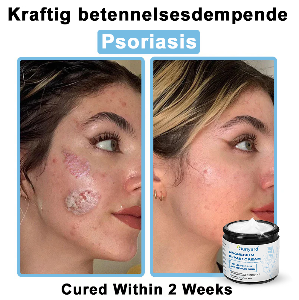 🏆✅Mayo Clinic Official: Magnesium skin repair cream (Eczema and Psoriasis Relief, Skin Repair, Even Tone, Acne and Dark Spot Treatment, Wart and Mole Removal)