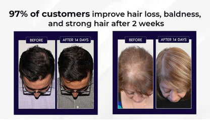 🌿 Odeiun™ Natural Hair Regrowth Spray – 70% OFF Ends Tonight! 🔥