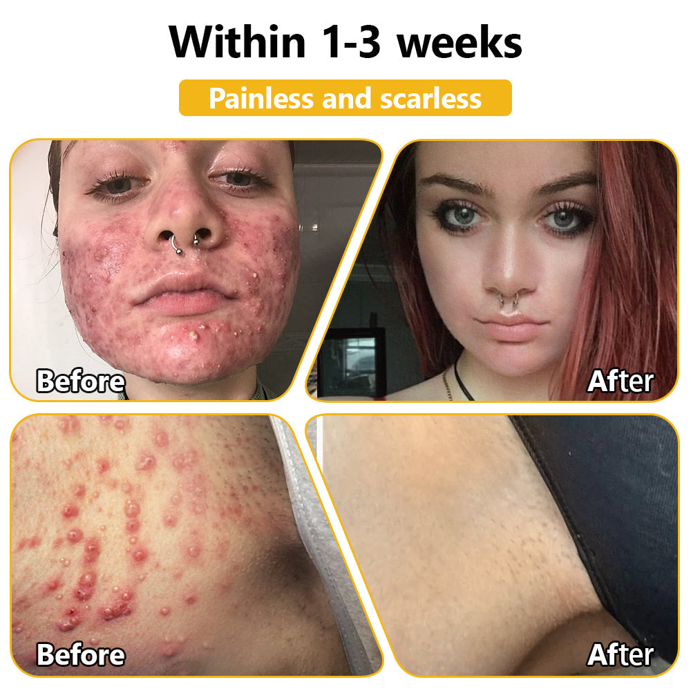𝗧𝗟𝗢𝗣𝗔® Bee Venom Skin Treatment Cream (AAD Recommended👨‍⚕️)💖💟